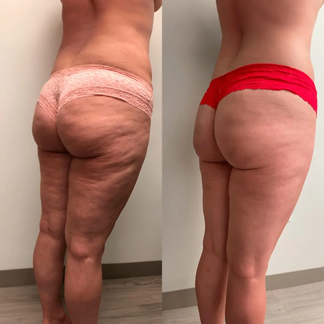 Antes e depois nas coxas e glúteos: celulite suavizada